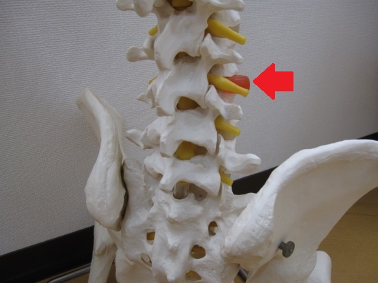 腰椎椎間板ヘルニア模型