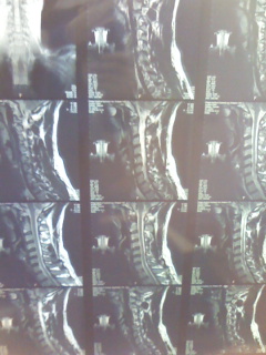 MRI核磁気共鳴画像法 首ヘルニア