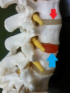 骨格模型、椎間板ヘルニア矢印