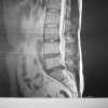 腰椎椎間板ヘルニア、MRI画像コピー
