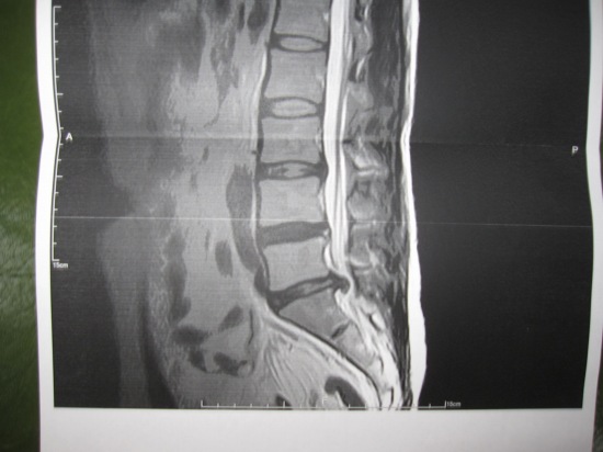 腰椎椎間板ヘルニア、MRI画像コピー 