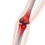 肘痛,ゴルフ肘,テニス肘,上腕骨内側上顆炎,上腕骨外側上顆炎