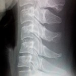 首,頸椎,レントゲン,CT,MRI,検査,ストレートネック,椎間板ヘルニア,脊柱管狭窄症