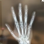 レントゲン、画像診断、手、骨折、検査